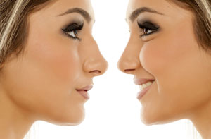 Rhinoplasty UK
