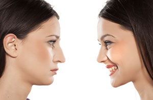 Rhinoplasty Bexley Greater London (DA5)